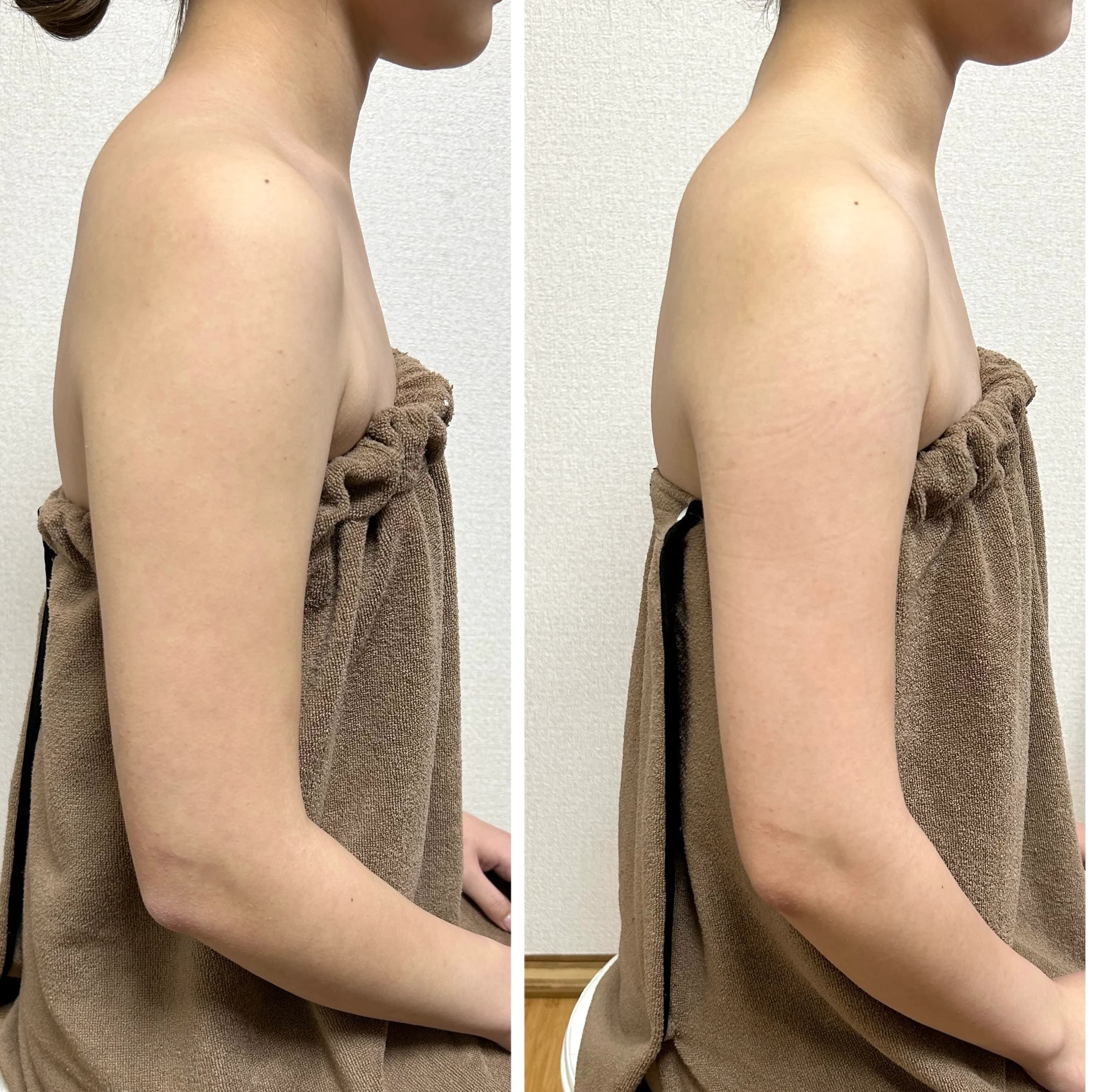 ノースリーブが着たい方のケア 施術事例