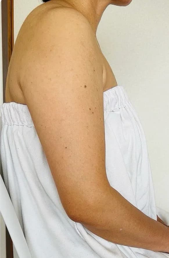 振袖肉スッキリ改善 施術前