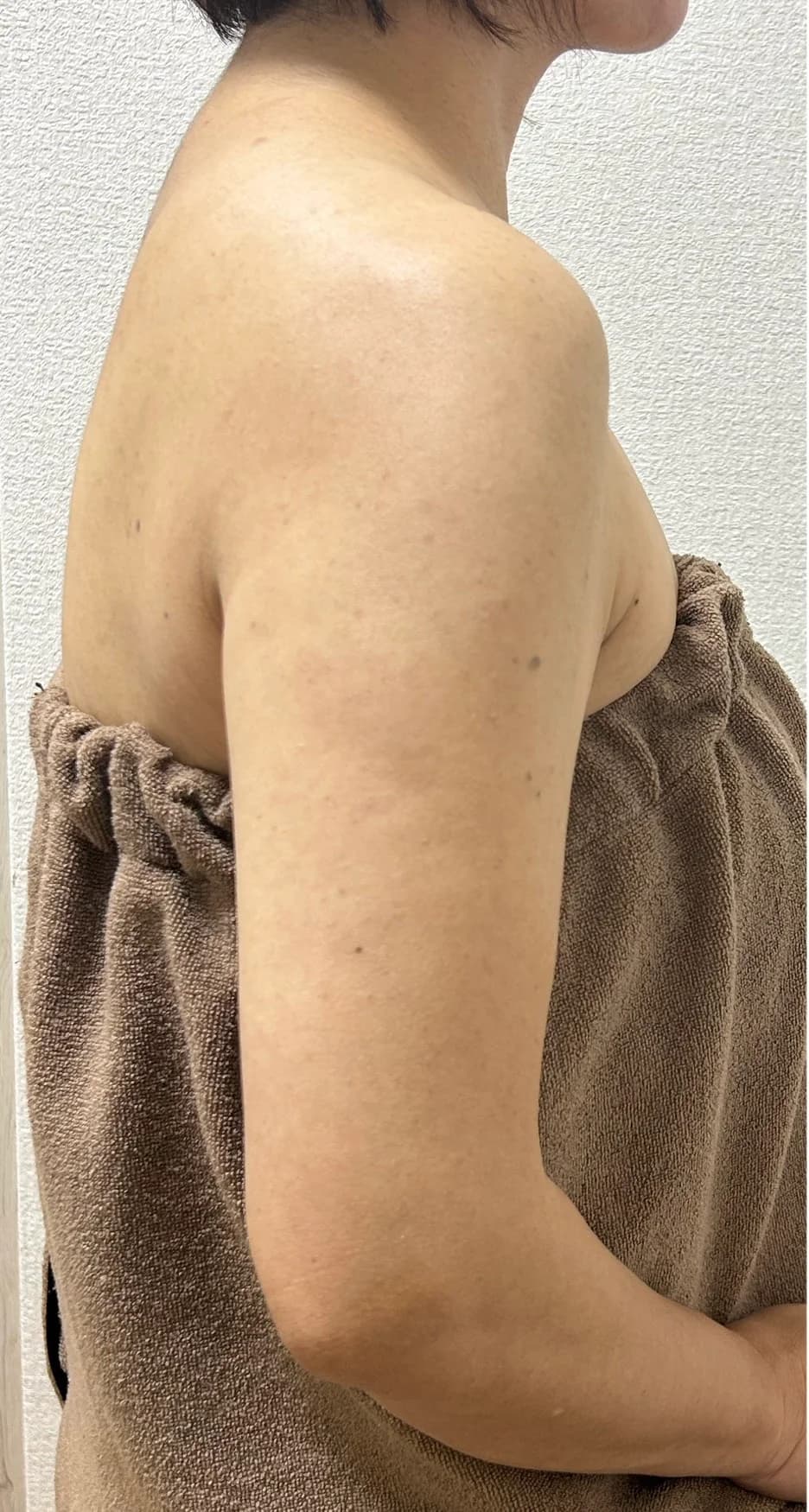 振袖肉スッキリ改善 施術後