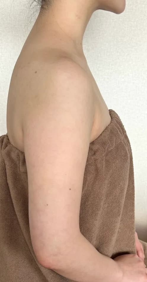二の腕・背中まわりスッキリ 施術前