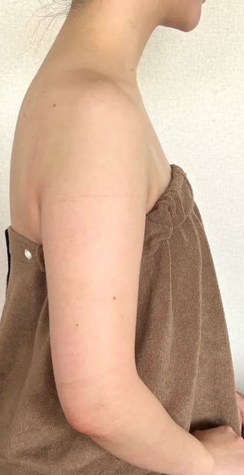 二の腕・背中まわりスッキリ 施術後