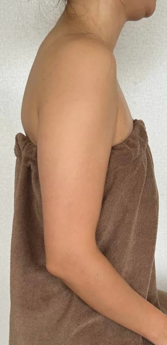 ブライダル二の腕ケア 施術前