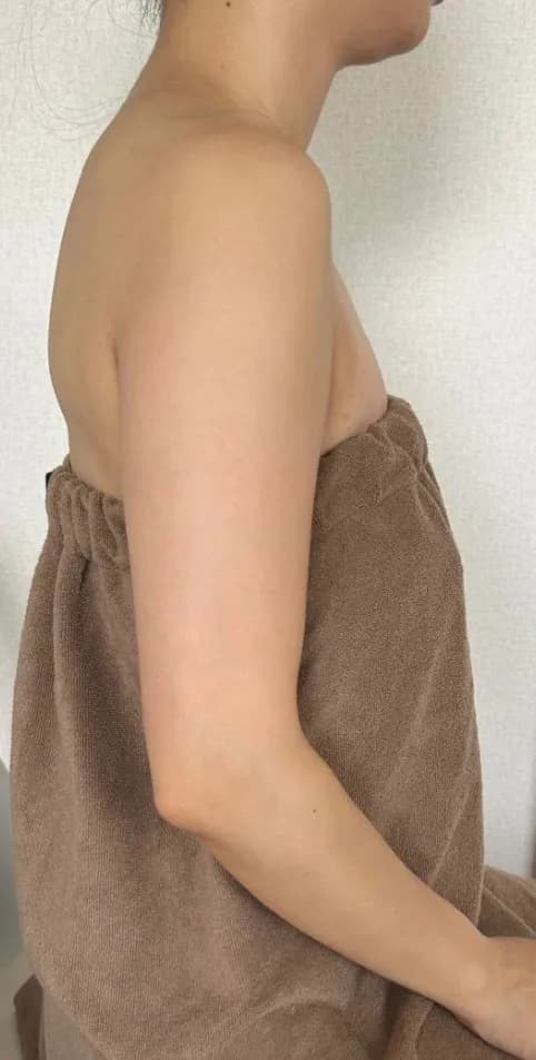 ブライダル二の腕ケア 施術後