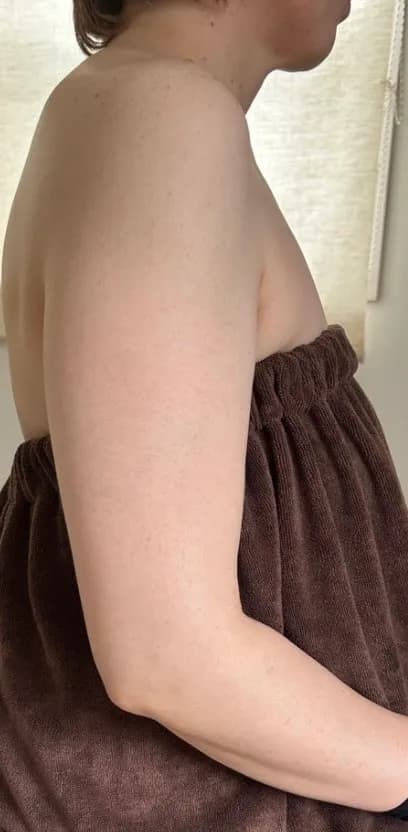 振袖・二の腕集中ケア 施術前