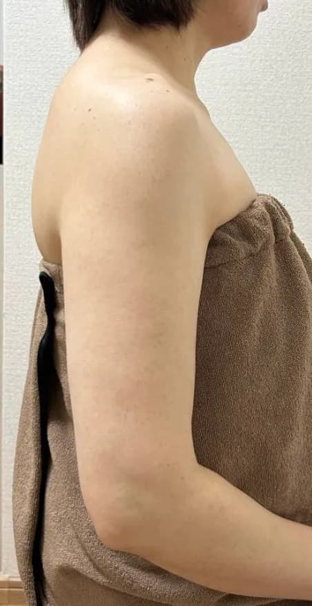 振袖・二の腕集中ケア 施術後