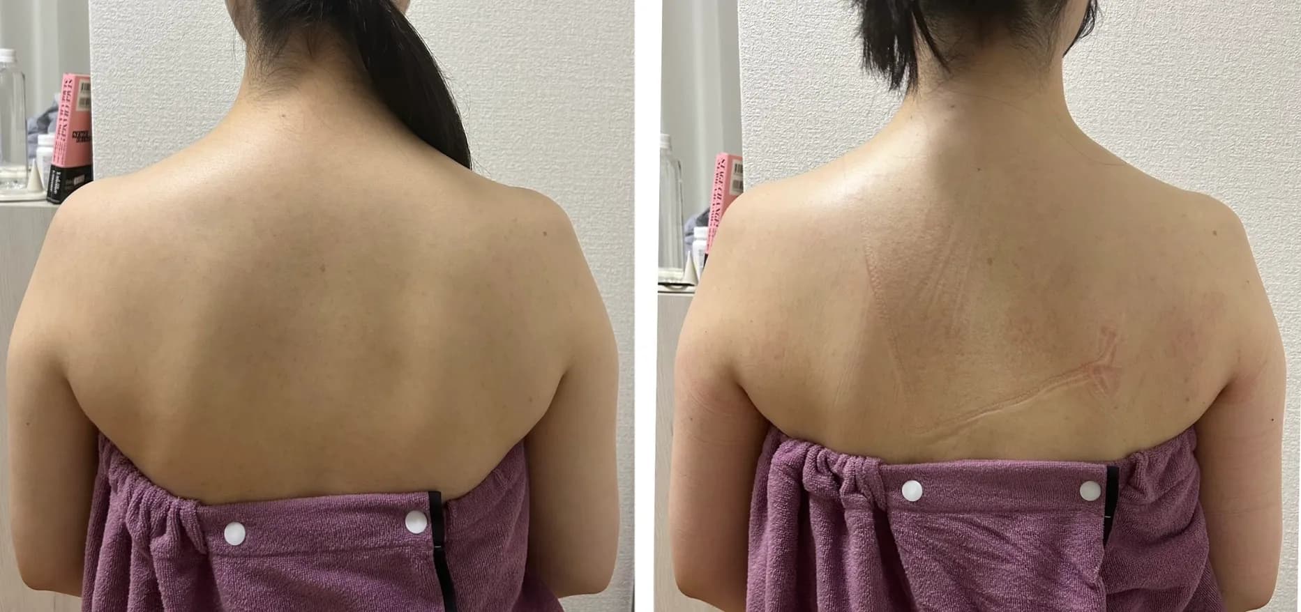 肩甲骨・二の腕まわり改善 施術事例