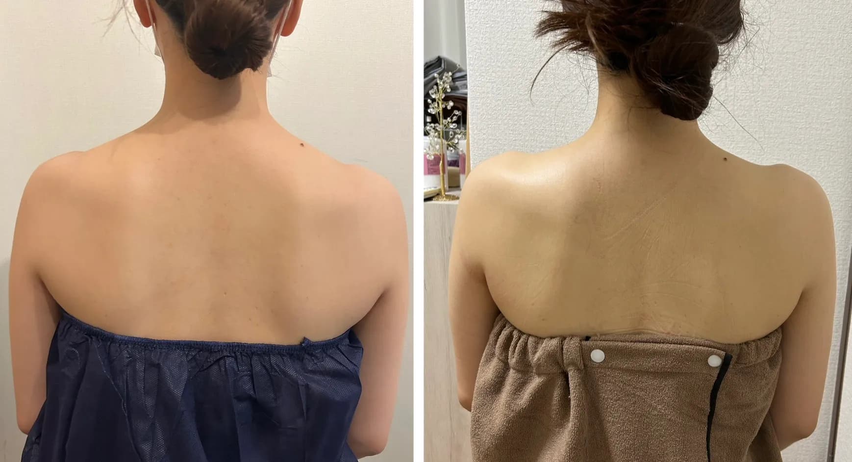 結婚式前の集中ケア 施術事例